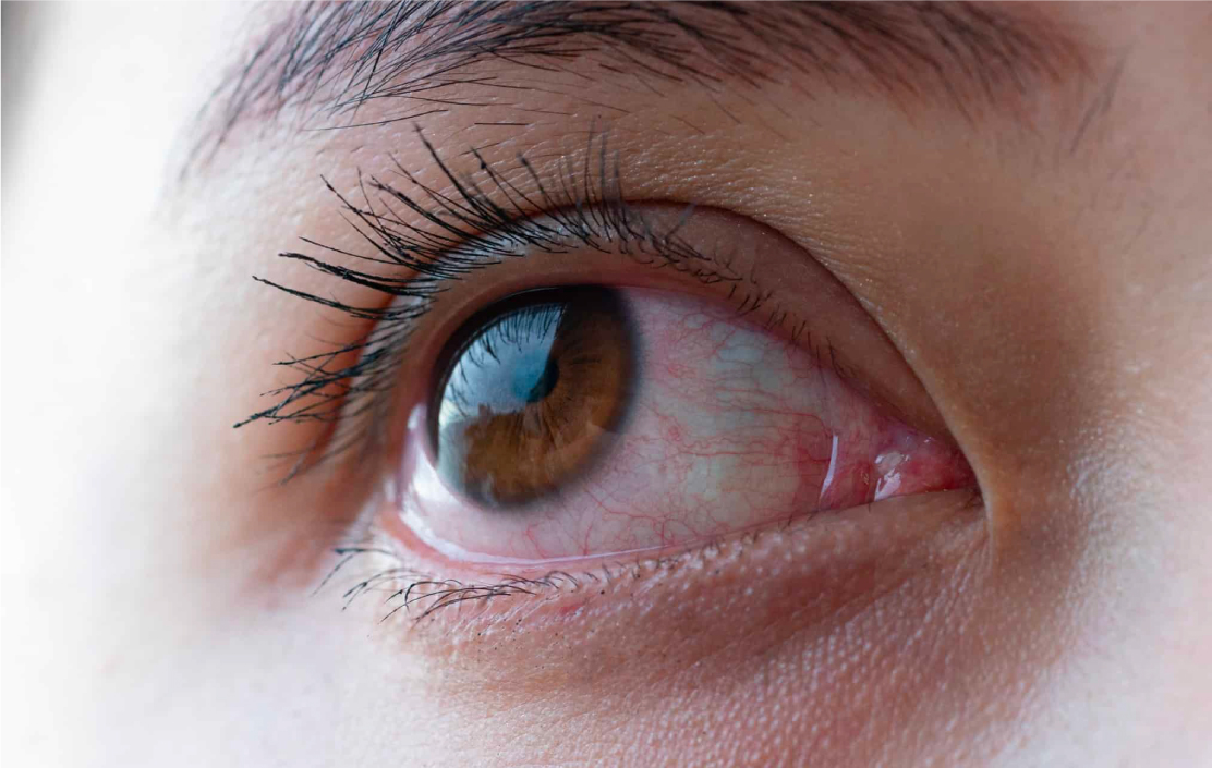 GLAUCOMA