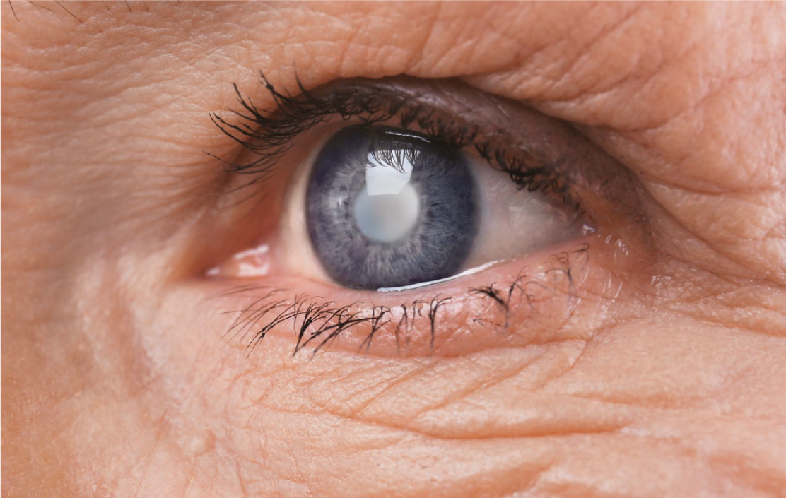 CATARACT